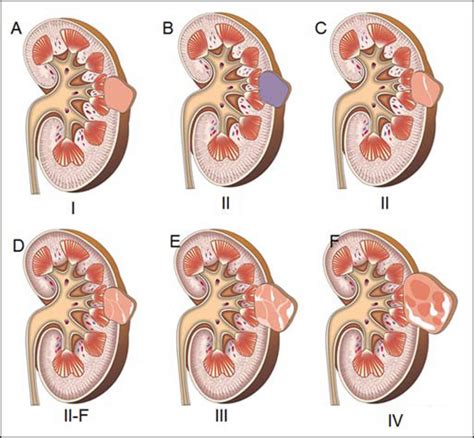 What Causes Hemorrhagic Cyst On Kidney